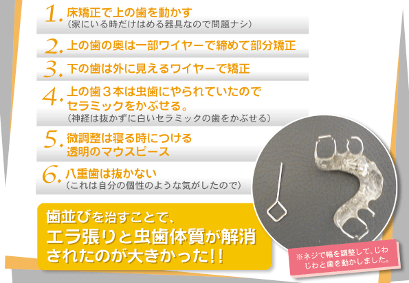 床矯正で上の歯を動かす/上の歯の奥は一部ワイヤーで締めて部分矯正床矯正で上の歯を動かす/上の歯３本は虫歯にやられていたのでセラミックをかぶせる。/微調整は寝る時につける/透明のマウスピース/重歯は抜かない